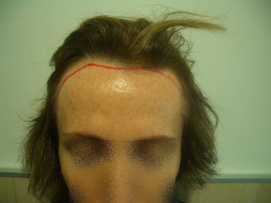 Que vitaminas beben a la caída de los cabello